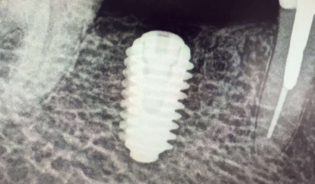 What implant this is?